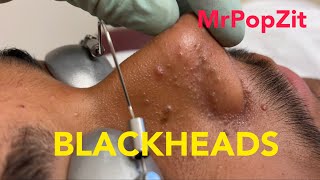 Tons of blackheads 17 minutes of extractionsBlackheads whiteheadsmilia Face and ears MrPopZit [upl. by Junette42]