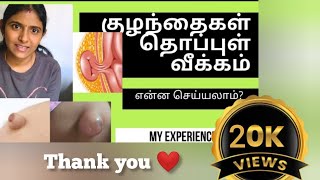 குழந்தைகளின் தொப்புள் வீக்கம் என்ன செய்யலாம் செய்யக்கூடாது  what is umbilical hernia how to cure [upl. by Llenej]