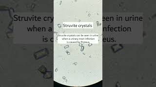 Struvite crystals under microscope seen when UTI caused by proteusmicroscopy urinalysis [upl. by Nahgeam48]