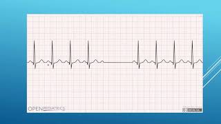 ECG Bradyarrhythmia [upl. by Yromas]