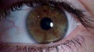 Nistagmus rotatorio  Rotary Nystagmus [upl. by Kcam890]