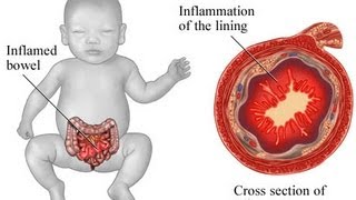 USMLE Medical Video Lectures about Necrotizing Enterocolitis by UsmleTeam [upl. by Gerri236]