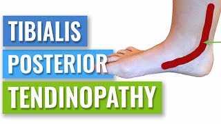 How to Get Rid of Posterior Tibial Tendonitis [upl. by Ymiaj]