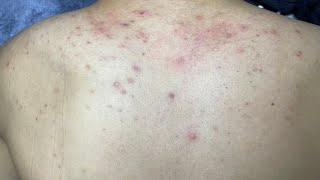 ACNE TREATMENT VU QUYNH MI  Acne On Back FULL [upl. by Harleigh]