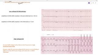 ALL ABOUT QRS COMPLEX [upl. by Aissela396]