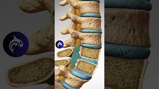 See How Spondylolisthesis Affects the Spine [upl. by Akcirehs803]