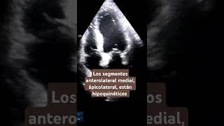 Hipoquinesia anterolateral medial y apical echocardiogram hipoquinesia akinesia infarto [upl. by Anselma707]