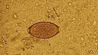 Trichuris trichiura in stool microscopy [upl. by Nrol]