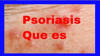 Psoriasis  Diagnostico  Sintomas  Tipos  Causas  Tratamiento [upl. by Berfield253]