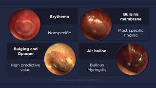 Acute Otitis Media Otoscopic Findings [upl. by Garrot904]