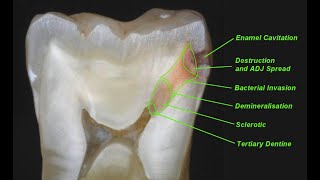 Dental Caries advanced lecture dentalcariesoperativedentistry [upl. by Glaudia230]