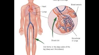 pulmonary embolism treatment [upl. by Olmsted]