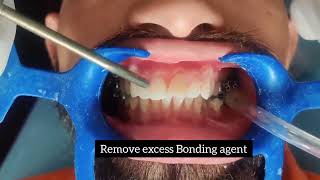 Orthodontic Bonding Procedure [upl. by Claudie]