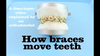 How braces move teeth timelapse  Braces Explained [upl. by Kenzi511]