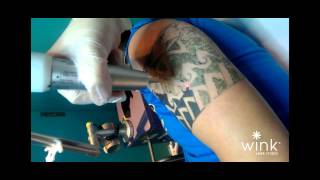 WINK REVLITE TATTOO REMOVAL [upl. by Sined]