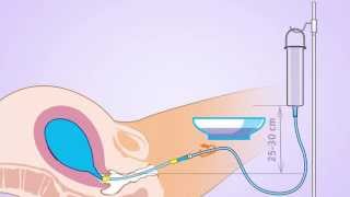 Usage of the Zhukovsky Balloon Tamponade for PPH Free Flow balloon tamponade with logo [upl. by Fonville]