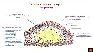 atherosclerosis morphology and consequences [upl. by Rases]