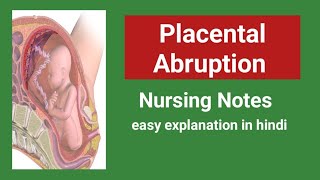 Placental abruption Abruptio placentae nursing Noteseasy explanation in hindi [upl. by Llertnom78]