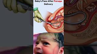 Baby After Birth Forceps Delivery shorts viral baby ytshorts birth youtubeshorts [upl. by Oniluap842]