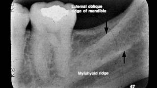 Dental Radiographic Anatomy [upl. by Aiam]