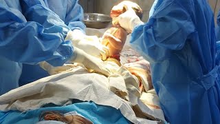 How to give Spinal Anaesthesia A Doctors Advice doctor youtubevideos anaesthesia [upl. by Sonafets]