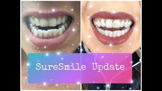 SureSmile Update  Invisalign Invisible Aligner Tips and Tricks [upl. by Ahseya]