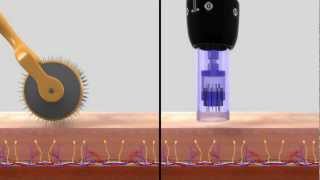 DERMAPEN SISTEMA DE REMODELACIÓN TISULAR [upl. by Faxen]