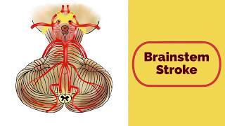 Brainstem Stroke Syndromes [upl. by Hibbert]