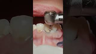 Loose gums and tooth decay repair the dentist Fill the🦷beadrepaircheapsavemoneyfillfixtooth [upl. by Craggie]