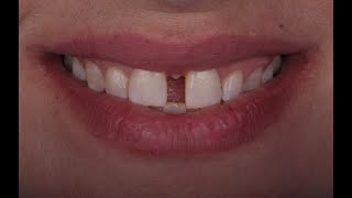 A combined approach for diastema closure [upl. by Dickinson622]