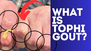 Tophi Gout Part 2  Tophaceous Tophi Gout Explained and Questions Answered [upl. by Yerrot]