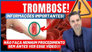 TROMBOSE Sintomas de trombose causas e tratamentos  Dr Alex Vascular [upl. by Aile]