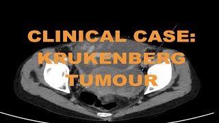 Clinical case  Metastatic cholangiocarcinoma cancer on CT abdomen  How to read and diagnose [upl. by Stephania]