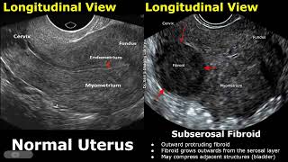 Uterus Ultrasound Normal Vs Subserosal Fibroid Images  Uterine Leiomyomas Cases  Pelvic USG Cases [upl. by Nodnerb]