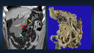 Which will regress which will not  Abdominal lymphangioma [upl. by Lundberg204]