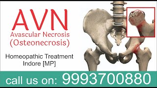 Avascular necrosis AVN osteonecrosis Homeopathic Treatment dr ak Dwivedi Anand Gujrat Vijay Patel [upl. by Lachus]