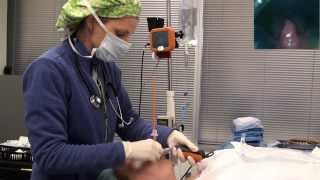 Video laryngoscope Tracheal intubation with Bougie Port [upl. by Ahserb]