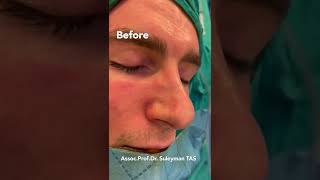 Male Revision Rhinoplasty  Closed Atraumatic Technique [upl. by Herrick]