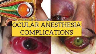 Complications of ocular anesthesia  Diagnosis and management [upl. by Kalbli]