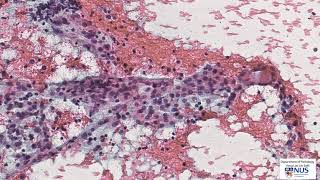 Thyroid cytology Lymphocytic thyroiditis [upl. by Annayt874]