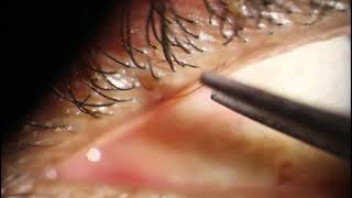 Trichiasis Epilation  TWO eyelashes out of ONE meibomian gland [upl. by Ahso976]