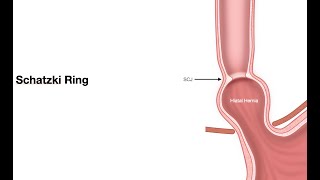 ECELesson 2f5Pathology of EsophagusSchatzki ring [upl. by Fesuoy]