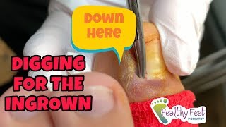 Digging For The Ingrown Nail Ingrown Nail Removal [upl. by Devinna]