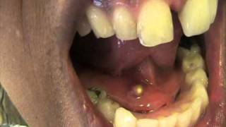 WARNING GRAPHIC AND NASTY Clogged Salivary Gland Stone Self removal and DRAINAGE [upl. by Gayner]