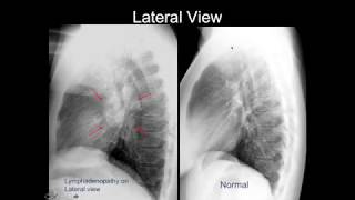 Chest Xray Cases 2 [upl. by Auop]