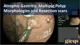 Atrophic Gastritis Multiple Polyp Morphologies and Resection scars [upl. by Kelly368]