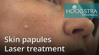 Skin papules  Laser treatment 21023 [upl. by Edurtreg]