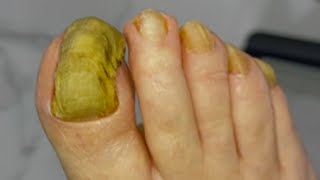 Huge ingrown toenail fungus treatment  Best video good healthy 01 [upl. by Tallia918]