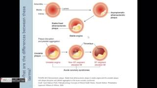 Angina Pathophysiology amp Treatment overview [upl. by Assyral]