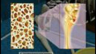 Osteoporosis3D Medical Animation [upl. by Netsud]